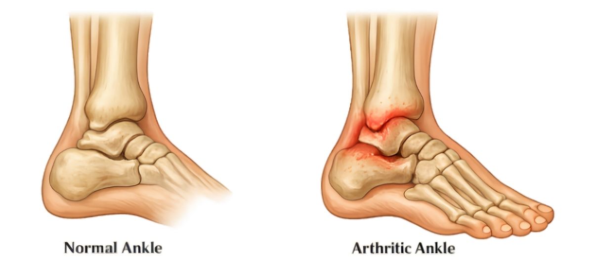 Ankle Arthritis